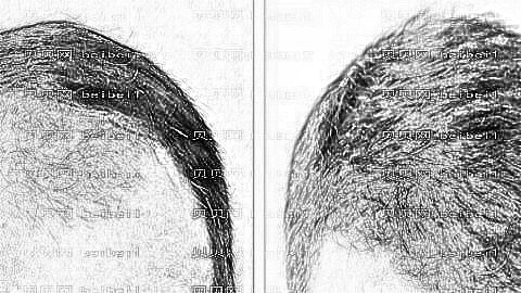 北京植发哪家医院好？多少钱？附北京植发医生排名名单