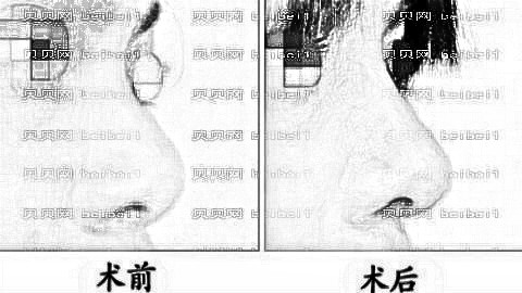 菏泽隆鼻哪家医院好？揭秘菏泽隆鼻医生排名前五榜单|附介绍