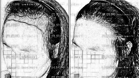 嘉兴植发哪家医院好？多少钱？附嘉兴植发医生排名名单