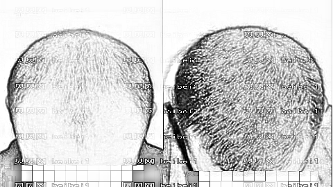 南宁植发哪家医院好？多少钱？附南宁植发医生排名名单