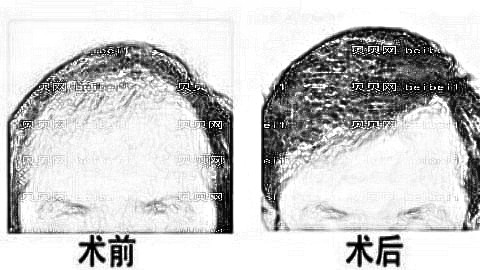 深圳植发哪家医院好？多少钱？附深圳植发医生排名名单