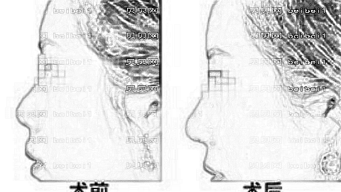 西安吴刚医生做鼻子自然吗？吴刚隆鼻口碑怎么样？附医生介绍