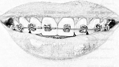 芜湖一院牙齿矫正怎么样?,凸嘴矫正介绍及