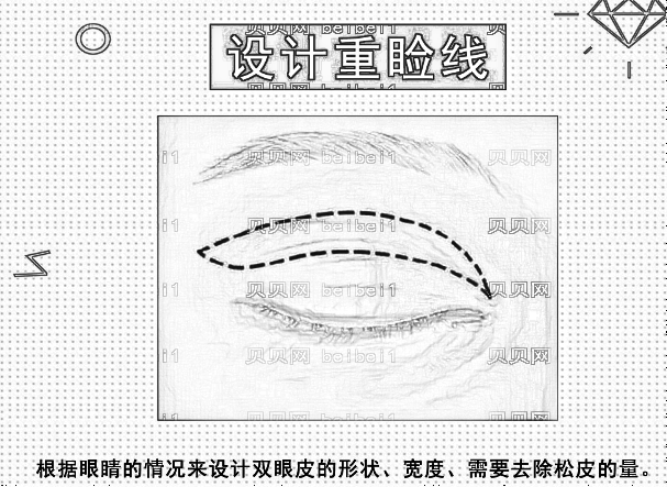 北京八大处宋维铭全切双眼皮+去脂肪怎么样?附手术恢复果一览