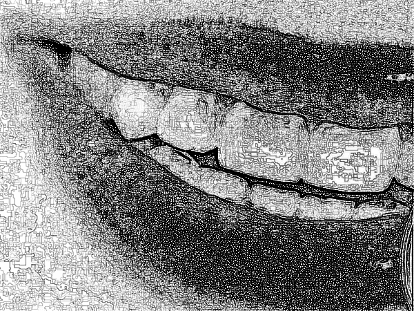 北京圣贝口腔牙齿种植怎么样?附手术恢复果一览