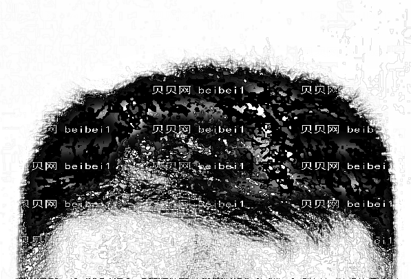 2022北京大学第三医院植发价格多少?做的怎么样