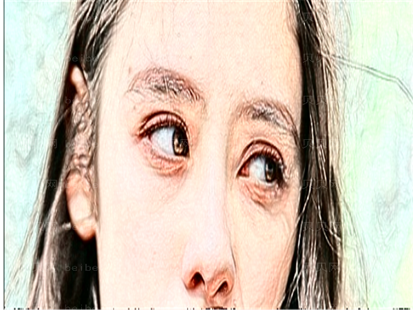 成都西婵整形医院眼睛割双眼皮技术怎么样？好吗？