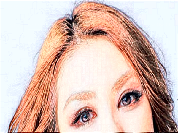 深圳港美双眼皮失败修复哪个医生好?果好吗?