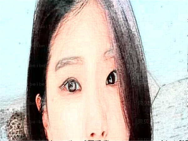 杭州美莱开眼角价格_开眼角开的是哪里