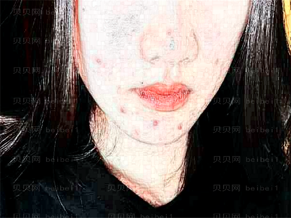 无锡坤如玛丽丰唇价格_丰唇能维持多久