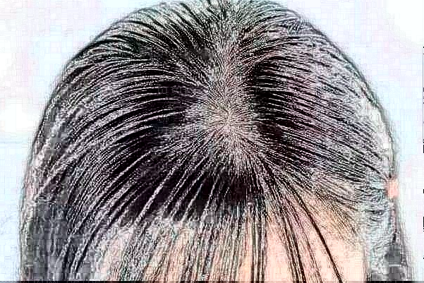 深圳毛发种植哪家医院比较好？排名前四名单一览