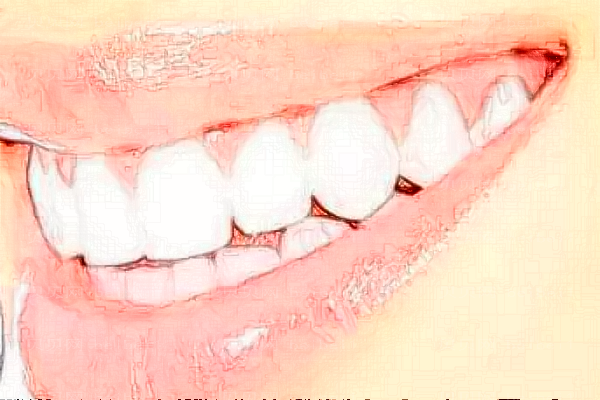 牙齿美白要多久时间?牙齿美白要多少钱