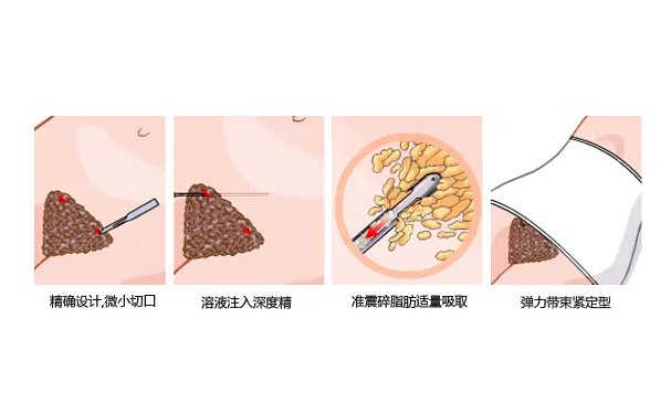 广州韩后吸脂技术咋样?价格实惠当地人都夸!