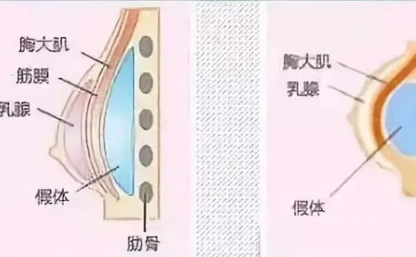 广州曙光假体隆胸价格多少钱?整形价格揭晓!