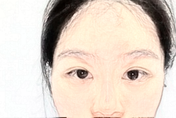 广州华美射频溶脂瘦脸哪个专家口碑好?