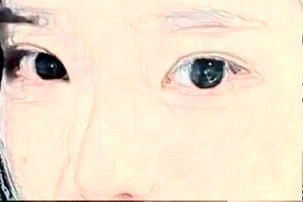 杭州连天美激光点黑痣怎么样？