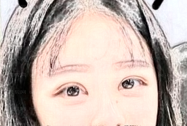 杭州连天美胶原蛋白填充泪沟廖宗源医生好不好？