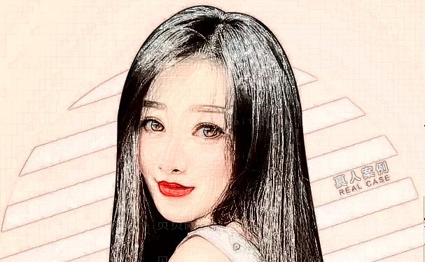 贵阳假体垫鼻基底医院名单一览