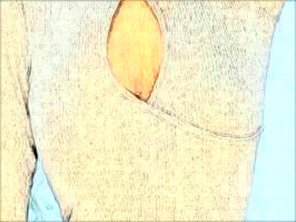 大连高岚自体脂肪隆胸怎么样?