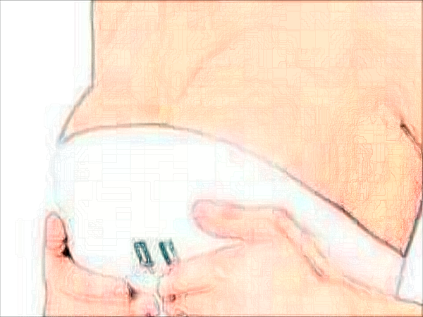 成都美容整形医院自体脂肪隆胸怎么样?