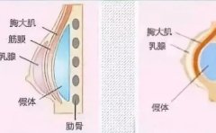 哈尔滨隆胸修复医生名单新鲜出炉