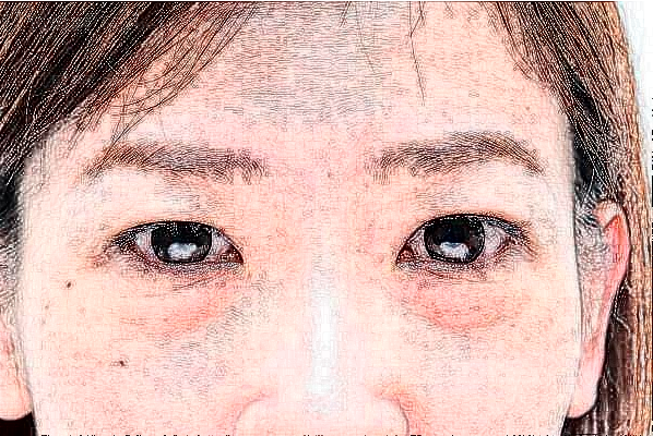 北京华悦府激光去黑眼圈朱燕医生怎么样？