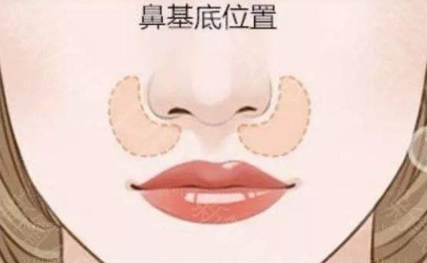常州乔雅登填充鼻基底医院怎么样