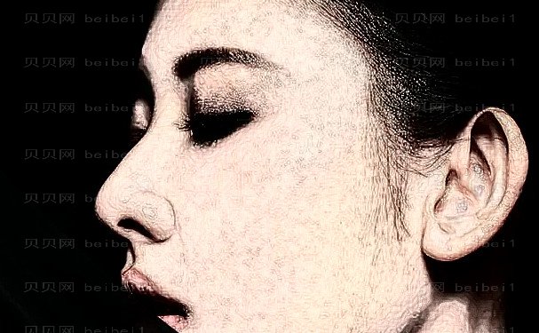 成都娇点李竞医生做鼻子怎么样?2024隆鼻案例一览