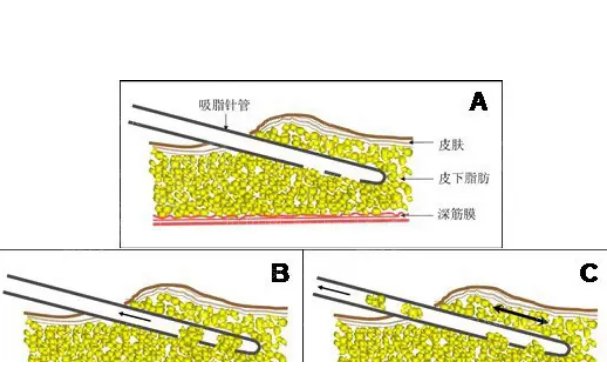 杭州维多利亚马腾抽脂怎么样？附抽脂恢复案例展示