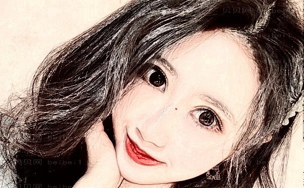 上海九院朱惠敏眼综合怎么样？真人反馈+恢复过程